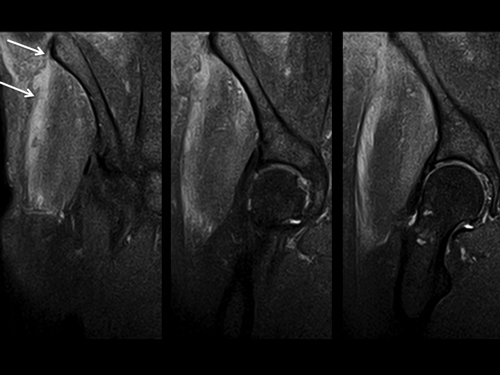 Figure 1 for case iliotibial band ( RID2855 )